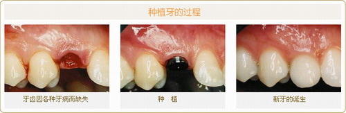 种植牙示意图